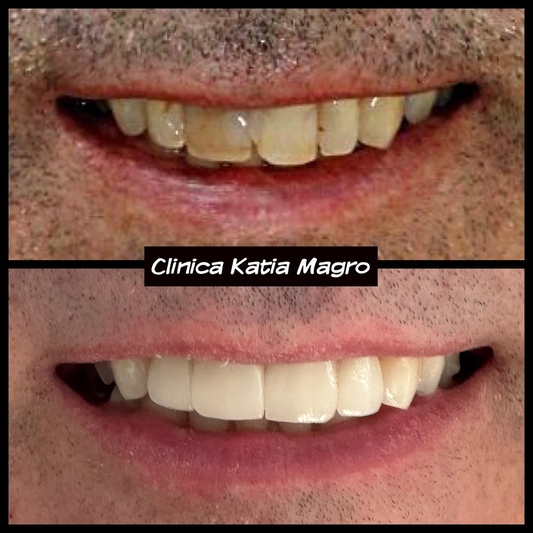 Reabilitação Estética Completa (antes e depois)